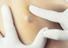 How to Dissolve a Cyst Naturally? How to Dissolve a Cyst Naturally?