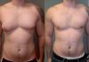 Unveiling the Journey to Confidence: Overcoming Gynecomastia in Dubai Gynecomastia in Dubai